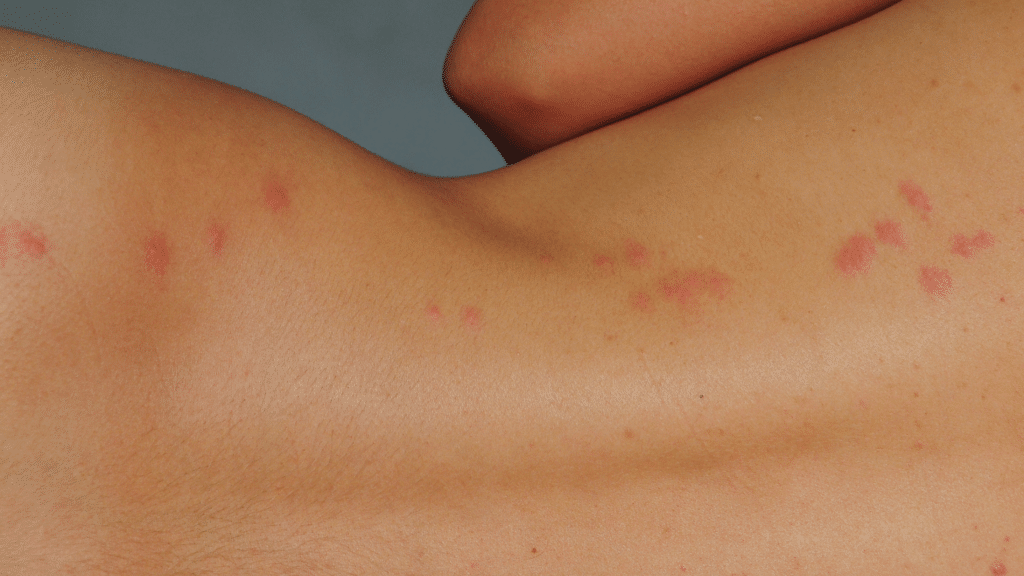 Bed Bug Bites